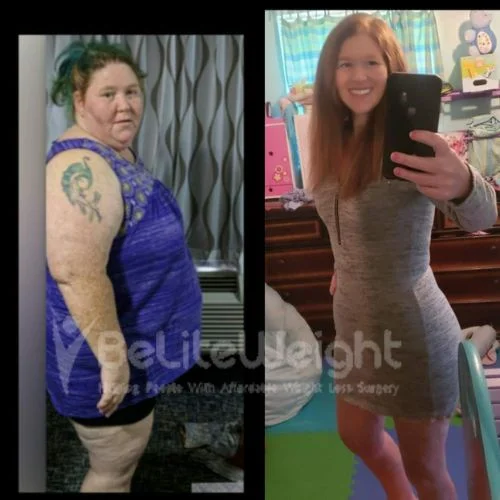 Rose. M .N - Mini Bypas update after 6 years*